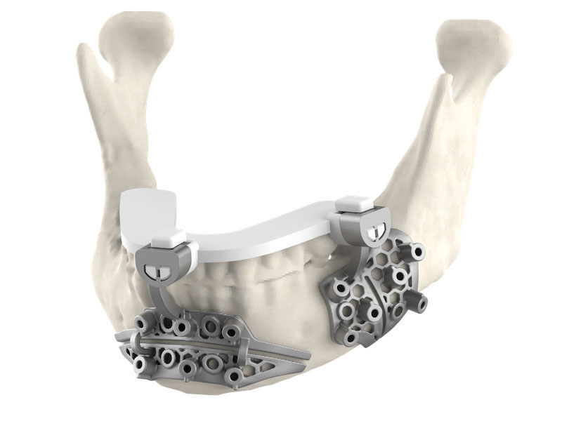 3D Systems ha già fornito modelli anatomici e soluzioni VSP per oltre 140.000 casi di pazienti unici.